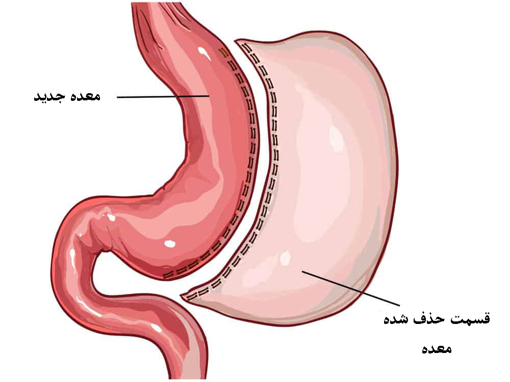 اسلیو معده