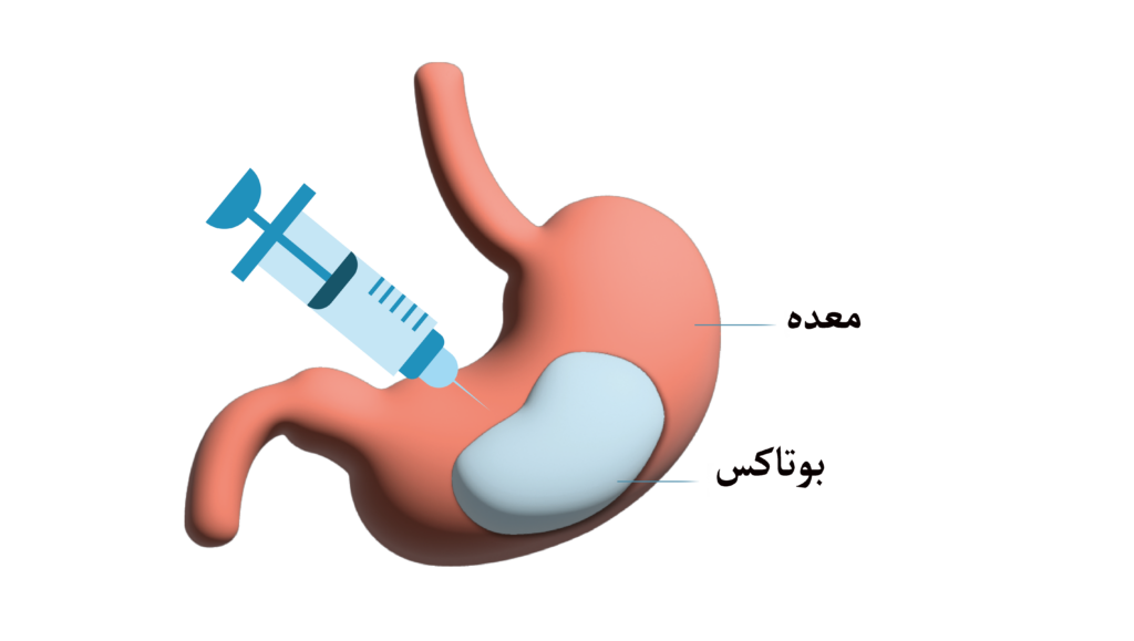 بوتاکس معده