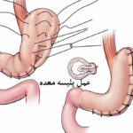 عمل پلیسه معده