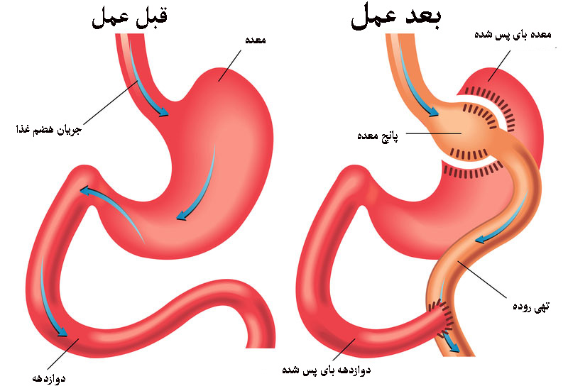 عمل بای پس معده