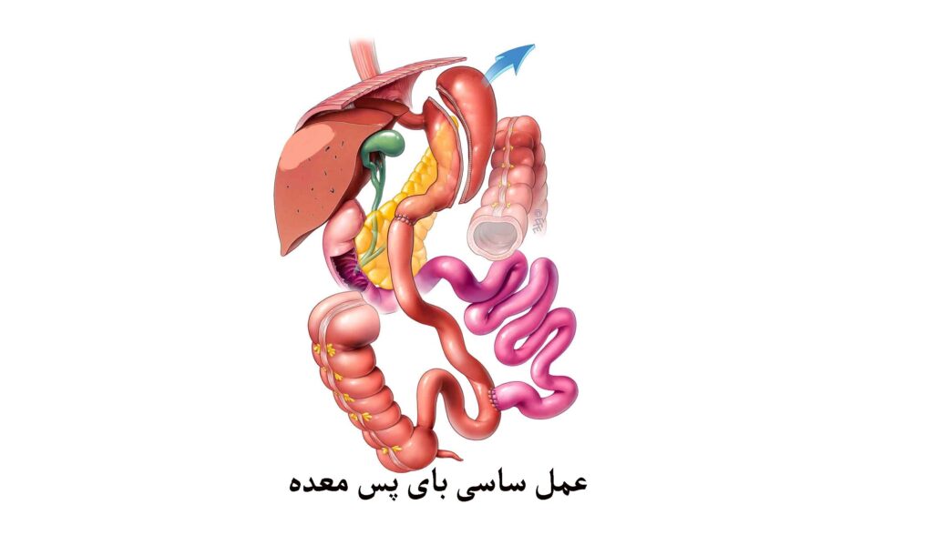 عمل ساسی بای پس معده