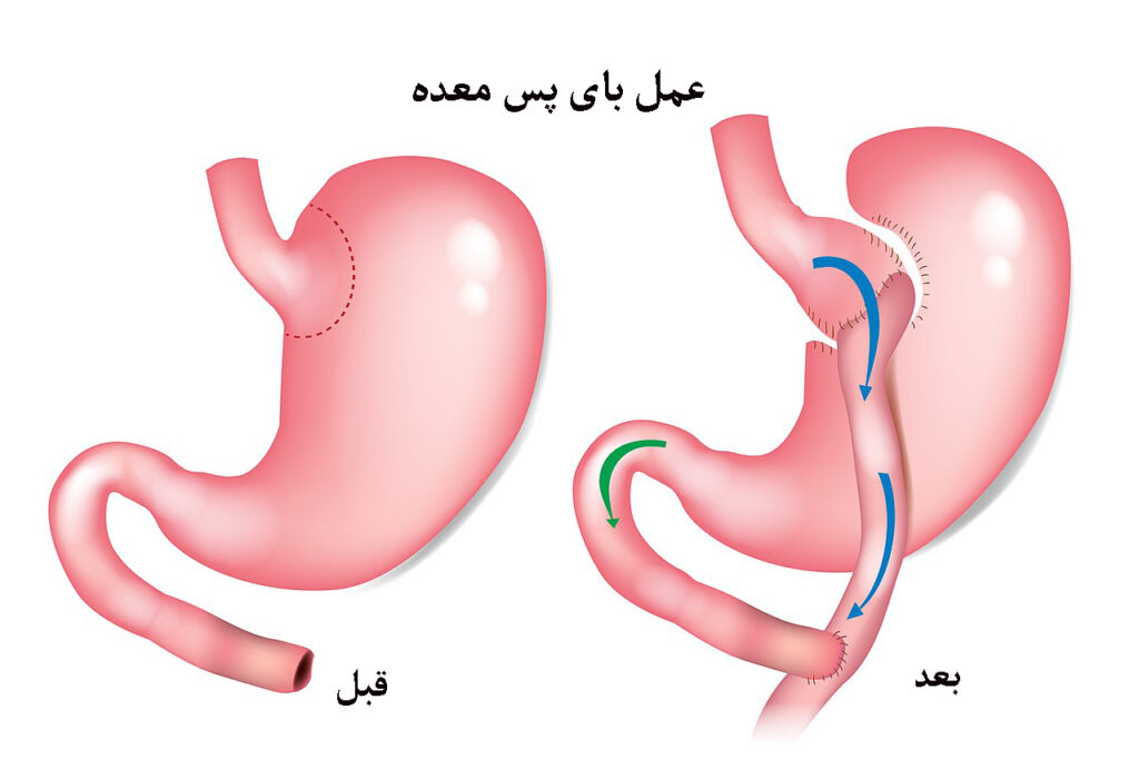 بای پس معده