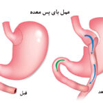 بای پس معده