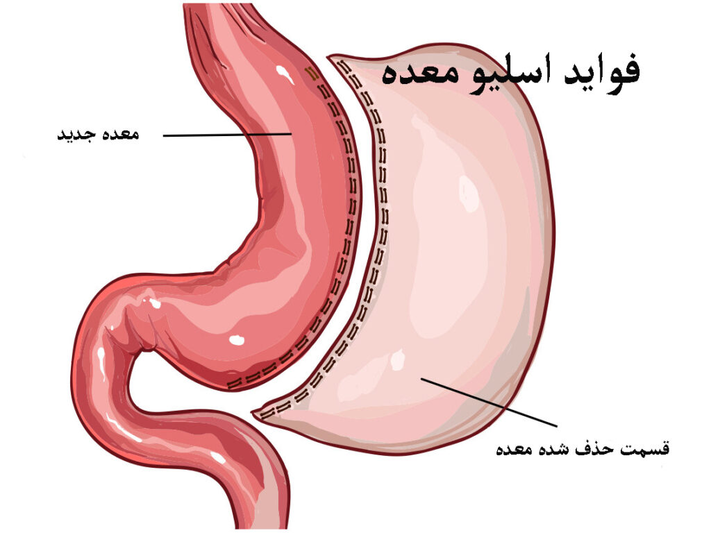 فواید اسلیو معده