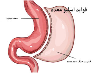 فواید اسلیو معده