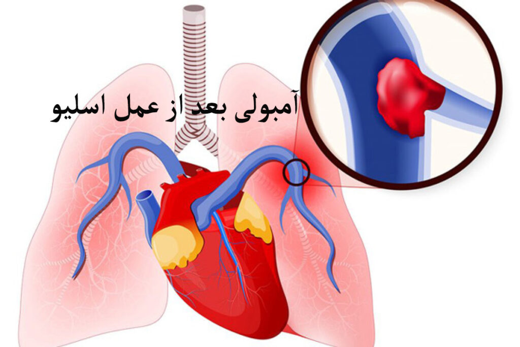 آمبولی بعد از عمل اسلیو