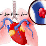 آمبولی بعد از عمل اسلیو