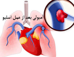 آمبولی بعد از عمل اسلیو