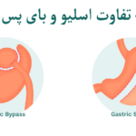 تفاوت اسلیو و بای پس معده