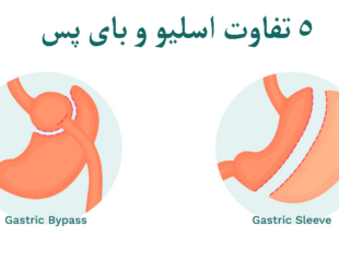 تفاوت اسلیو و بای پس معده