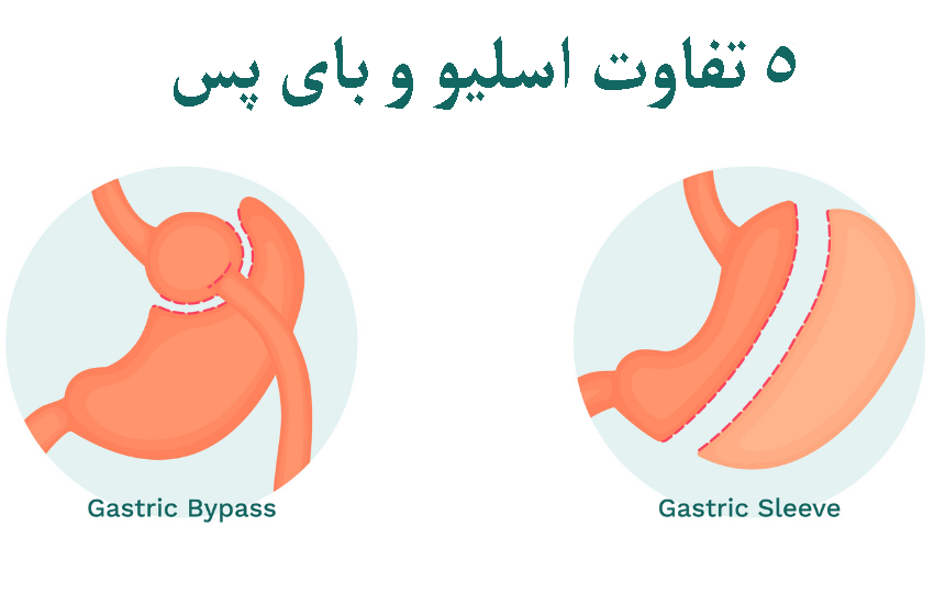 تفاوت اسلیو و بای پس معده