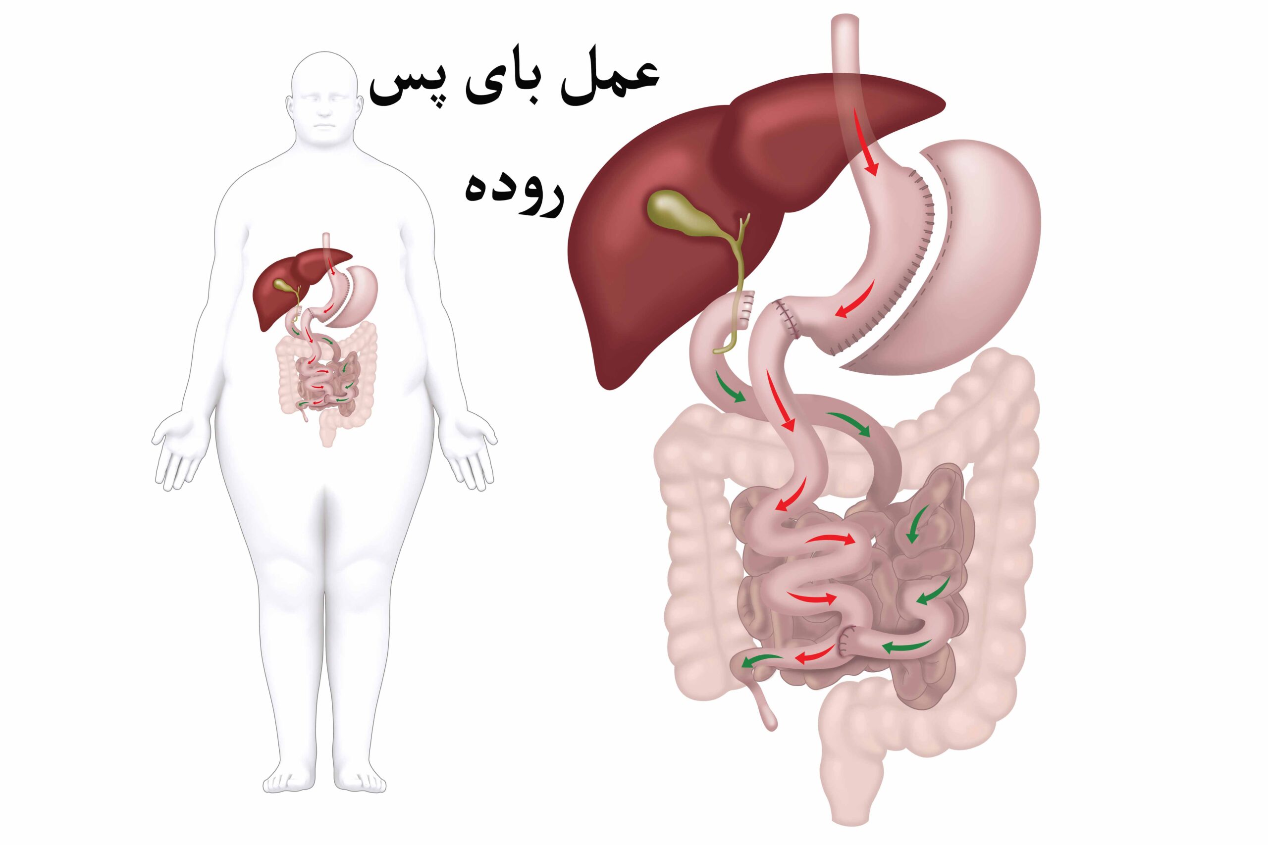 همه چیز درباره عمل جراحی بای پس روده - مزایا ، معایب و انتظارات بعد از عمل
