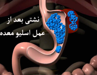 نشتی بعد از عمل اسلیو معده