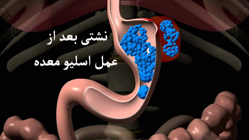 نشتی بعد از عمل اسلیو معده