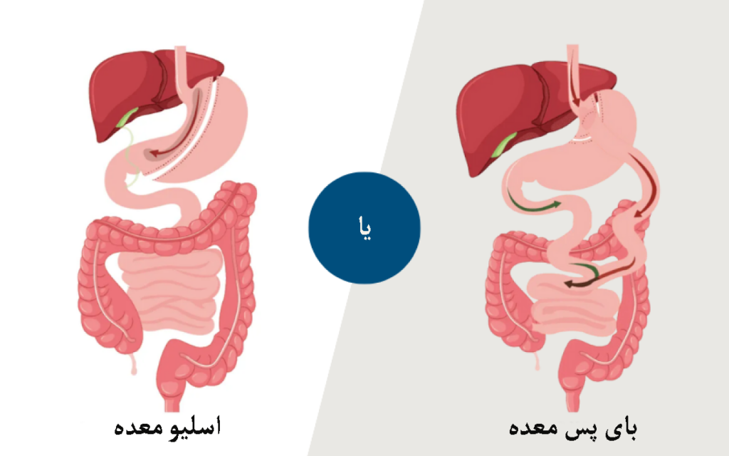 بای پس بهتر است یا اسلیو