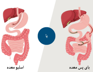 بای پس بهتر است یا اسلیو