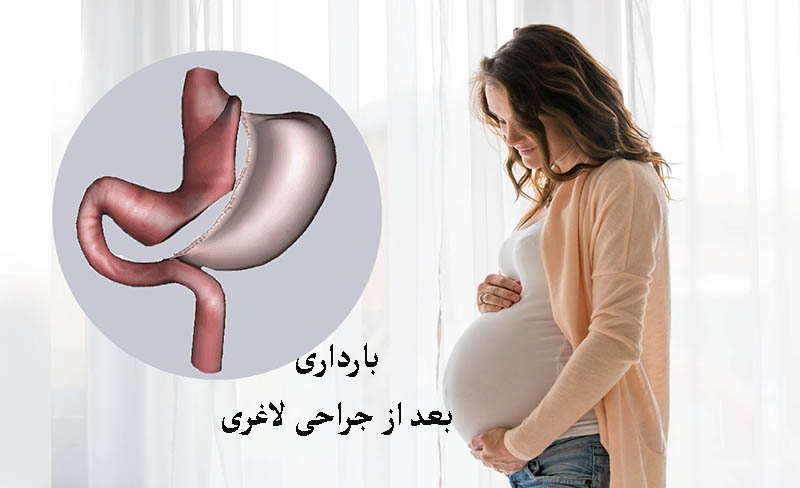 بارداری بعد از جراحی لاغری