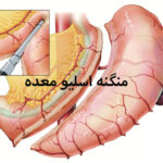 منگنه اسلیو معده