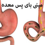 مینی بای پس معده