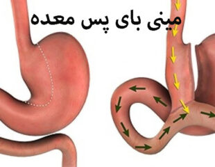 مینی بای پس معده