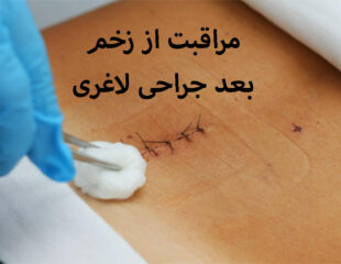 مراقبت از زخم بعد جراحی لاغری