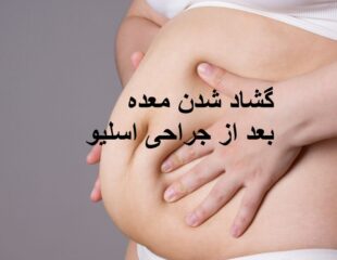 گشاد شدن معده بعد از جراحی اسلیو