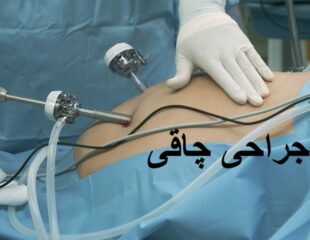 جراحی چاقی