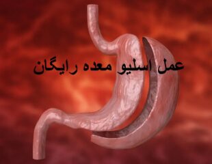عمل اسلیو معده رایگان